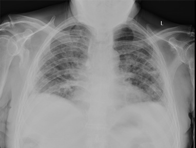 Chest xray